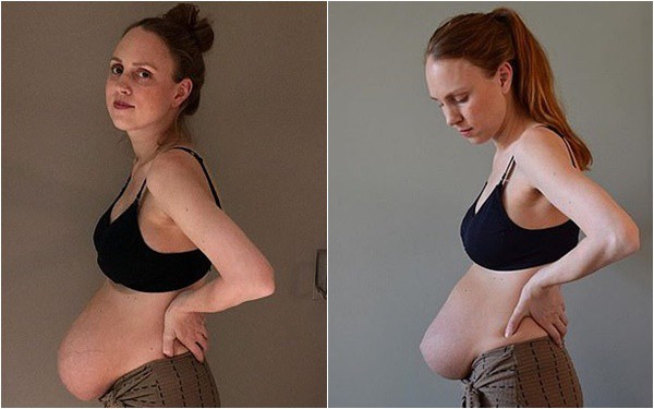 Bà mẹ sinh ba có bụng bầu dài bất thường lại gây sốt với vòng hai như chưa đẻ sau khi sinh 1 tháng - Ảnh 1.
