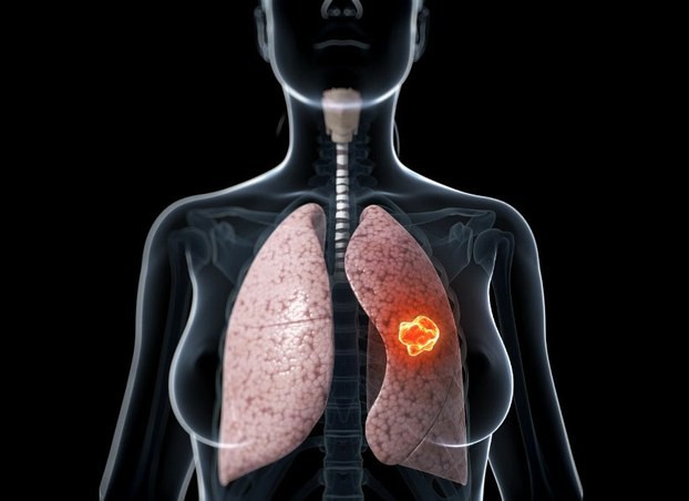 4 người cùng phòng làm việc bị ung thư phổi, báo động về nguy cơ bị ung thư ngay cả khi bạn không hút thuốc - Ảnh 3.