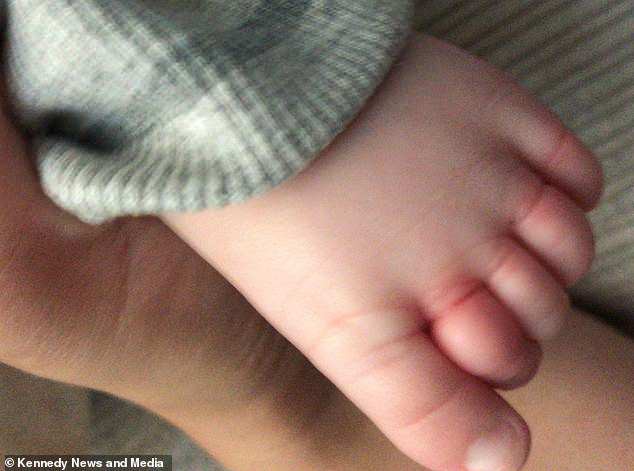 Bé 10 tuần tuổi không chịu bú sữa, chỉ la khóc, mãi tới khi thay bỉm mẹ mới phát hiện ra thủ phạm ở chân con - Ảnh 3.