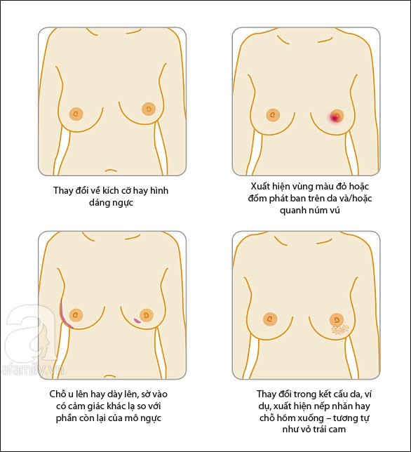 Dù ngực không có khối u nhưng nếu thấy có biểu hiện như trong bức tranh này thì bạn nên đi khám ung thư vú ngay kẻo muộn - Ảnh 4.