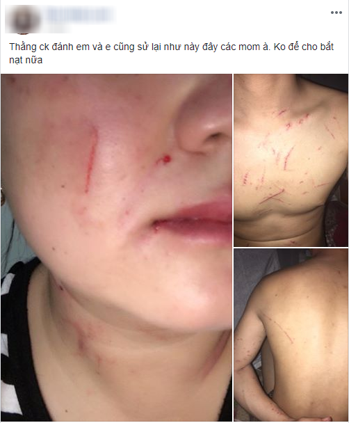 Vợ trẻ đăng đàn tố chồng đánh mình giữa đêm và màn phản pháo, nhưng dân mạng chỉ quan tâm điều này - Ảnh 1. Vợ trẻ đăng đàn tố chồng đánh mình giữa đêm và màn phản pháo, nhưng dân mạng chỉ quan tâm điều này - Ảnh 1.
