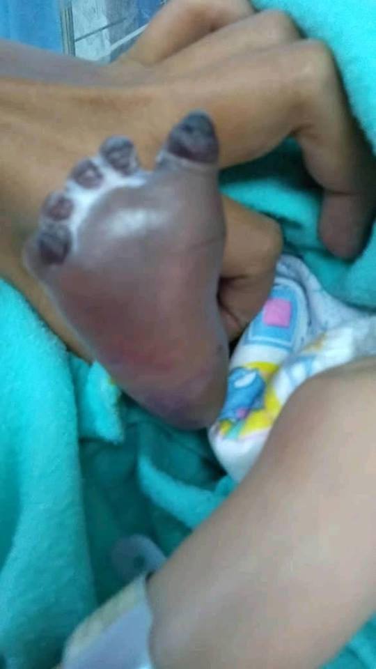 Chào đời hoàn toàn khỏe mạnh, nhưng sau khi lấy máu xét nghiệm, bàn chân bé sơ sinh bỗng thâm đen đến đáng sợ - Ảnh 4.
