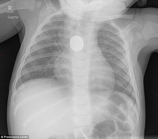 Tỉnh dậy trong vũng máu, bé 1 tuổi được chẩn đoán nhiễm trùng đường tiết niệu nhưng chụp X-quang thì mới biết nguyên nhân - Ảnh 3.