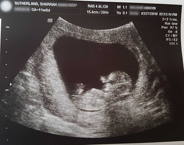 Kinh ngạc trước hình ảnh thai thi 14 tuần tuổi, xem xong những người có ý định phá thai phải suy nghĩ lại - Ảnh 3.
