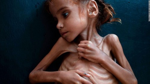 Ám ảnh nạn đói tại Yemen: 85.000 trẻ em tử vong vì thiếu dinh dưỡng - Ảnh 1.