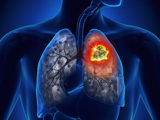 Tưởng bị viêm phổi ai dè bị ung thư phổi, người phụ nữ hối hận vì bỏ qua dấu hiệu quan trọng này - Ảnh 1.