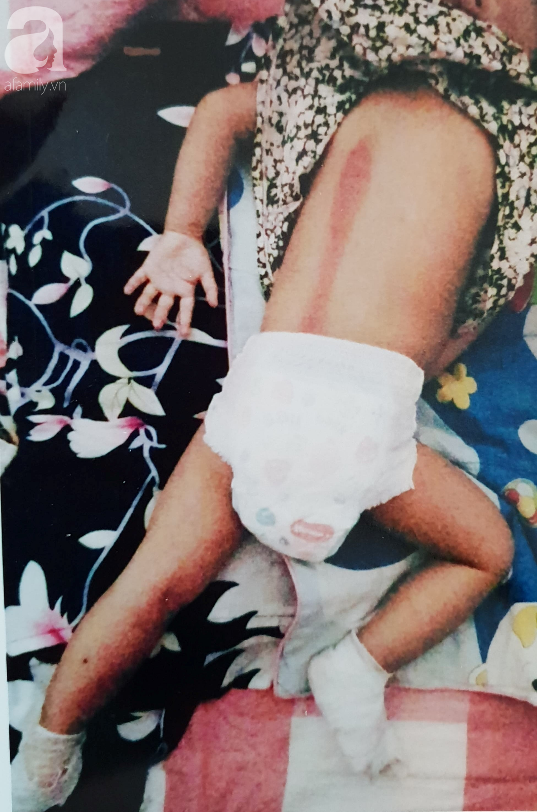 Cơ sở giữ trẻ lên tiếng việc bé gái 18 tháng tuổi bị phỏng ở chân: Không ai nhúng chân bé vào nước sôi - Ảnh 4.