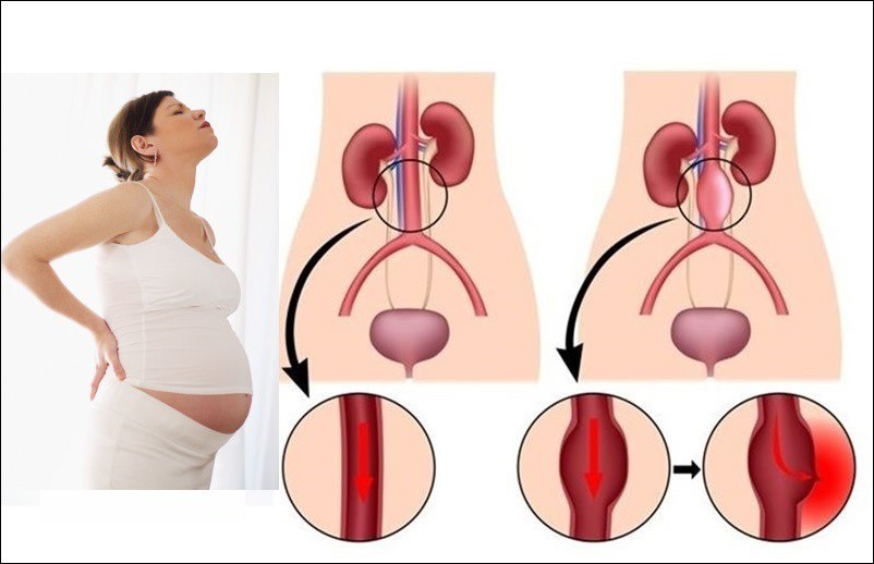Có một hiện tượng trong thai kì có thể khiến máu lưu thông kém, gây nguy hiểm tới mẹ và bé - Ảnh 2.