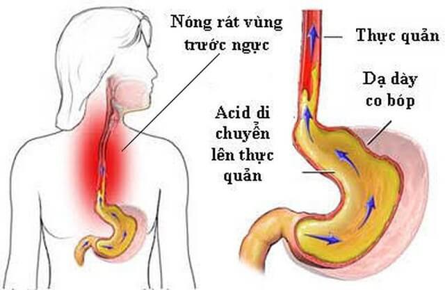 Chuyên gia Tiêu hóa BV Bạch Mai chia sẻ tư thế ngủ tốt cho dạ dày, tránh trào ngược - Ảnh 1.