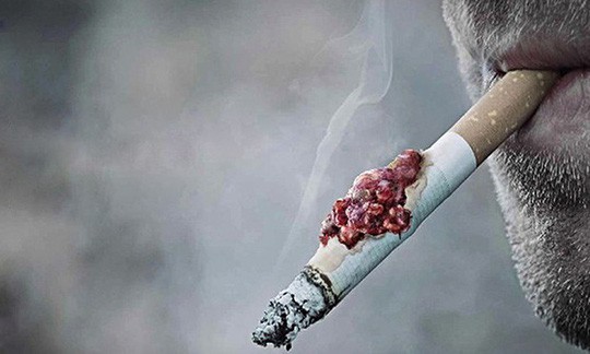 Nam thiếu niên 15 tuổi bị ung thư phổi nghi hút thuốc lá thụ động từ bố - Ảnh 2.