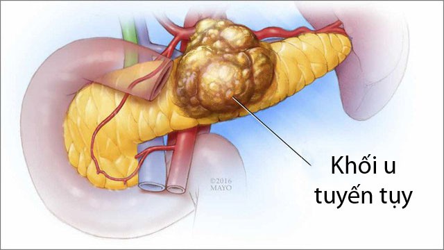 Đây là những dấu hiệu cảnh báo bạn có thể mắc một trong những bệnh ung thư cướp đi nhiều sinh mạng bệnh nhân nhất - Ảnh 1.