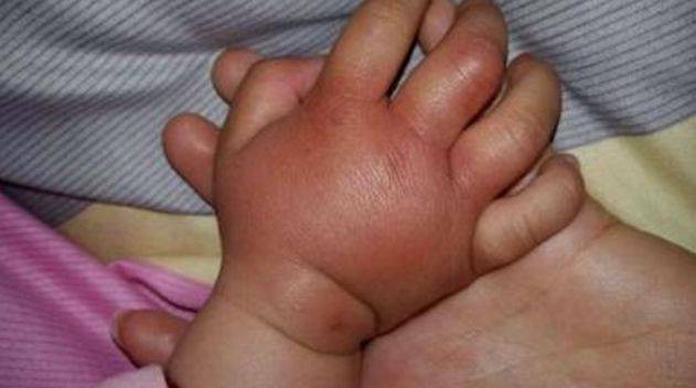 Bàn tay bé 5 tháng tuổi sưng phồng như bánh bao, bố ân hận khi bác sĩ tiết lộ kết quả chụp X-quang - Ảnh 1.