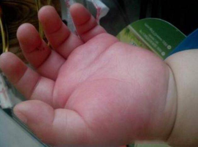 Bàn tay bé 5 tháng tuổi sưng phồng như bánh bao, bố ân hận khi bác sĩ tiết lộ kết quả chụp X-quang - Ảnh 2.