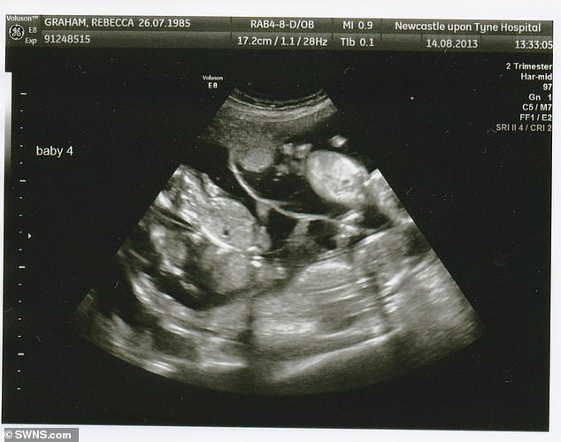 Siêu âm thai ở tuần 12, bà mẹ phát hiện một cơn chấn động thực sự - Ảnh 2.