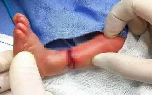 Con vừa chào đời mẹ hốt hoảng khi bác sĩ thông báo phải cắt bỏ chân con vì hội chứng thai kỳ ít người biết - Ảnh 1.