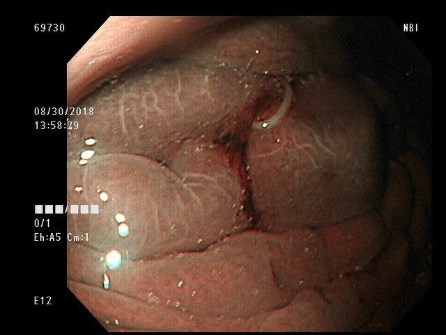 Cô gái 28 tuổi ăn hải sản và đau bụng dữ dội, bác sĩ phát hiện có ký sinh trùng trong dạ dày - Ảnh 2.