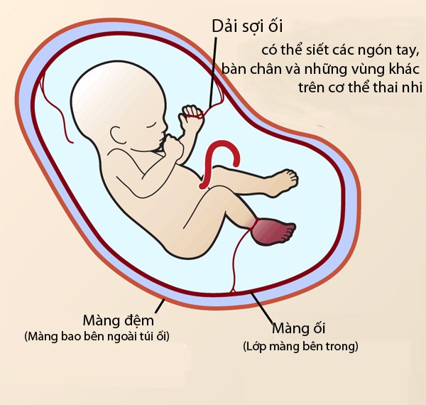 Con vừa chào đời mẹ hốt hoảng khi bác sĩ thông báo phải cắt bỏ chân con vì hội chứng thai kỳ ít người biết - Ảnh 3.