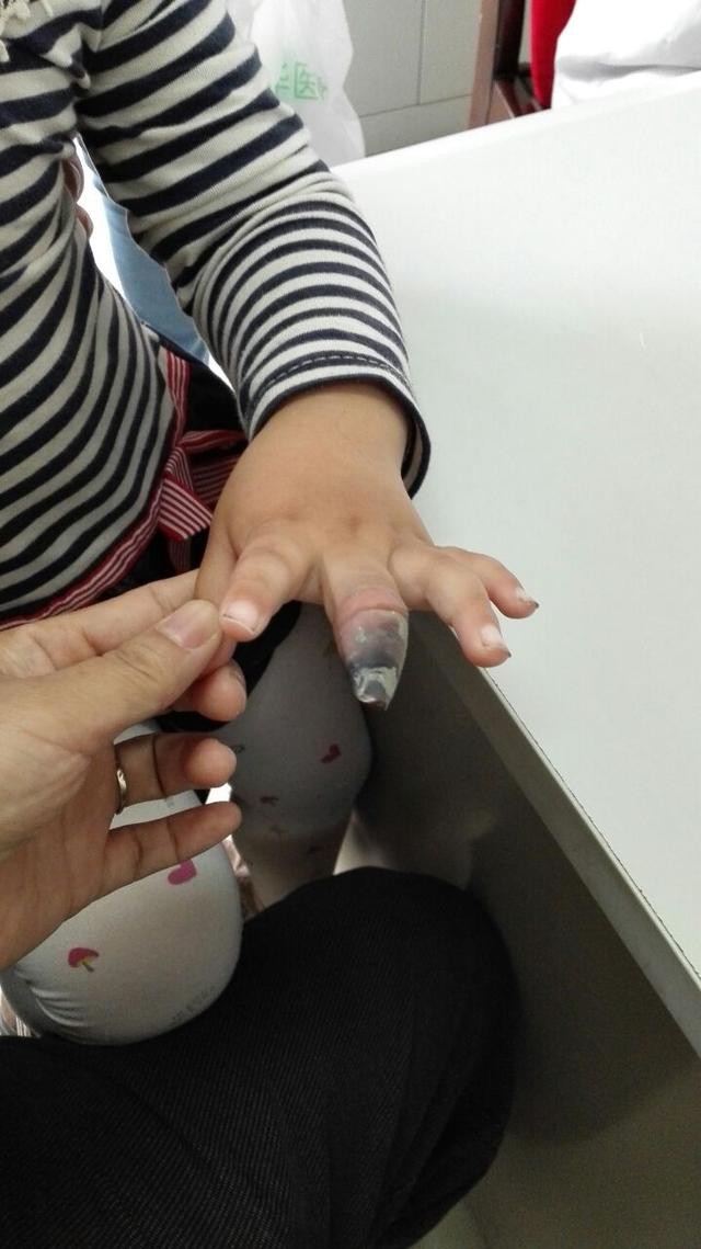 Bé 4 tuổi phải cắt cụt đầu ngón tay vì hoại tử do sai lầm của người lớn khi dùng miếng băng dán y tế - Ảnh 1.