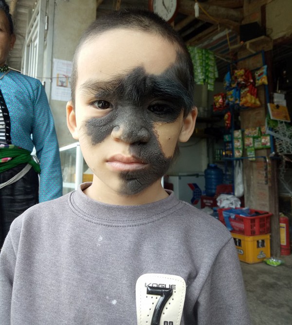 Cái Tết trọn vẹn đầu tiên của cậu bé 6 tuổi có khuôn mặt tựa người rừng tại Yên Bái - Ảnh 2.