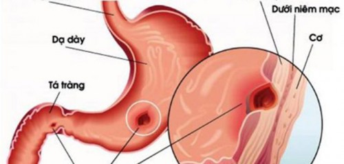 7 triệu chứng cảnh báo bạn bị viêm loét dạ dày - Ảnh 2.