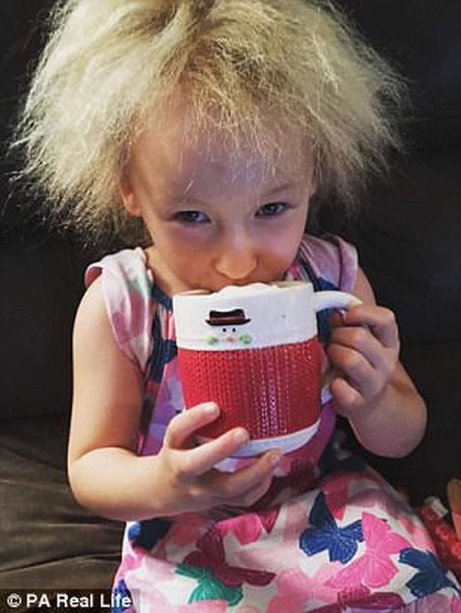 Cô bé 6 tuổi mắc hội chứng hiếm gặp khiến mái tóc dựng đứng bất thường - Ảnh 3.