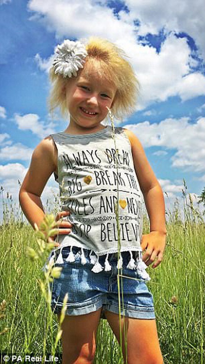 Cô bé 6 tuổi mắc hội chứng hiếm gặp khiến mái tóc dựng đứng bất thường - Ảnh 5.