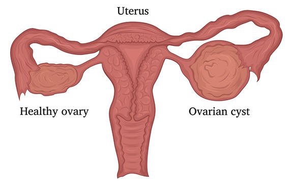 Nguyên nhân gây ra những cơn đau khung chậu nhưng rất ít người nghĩ tới - Ảnh 6.