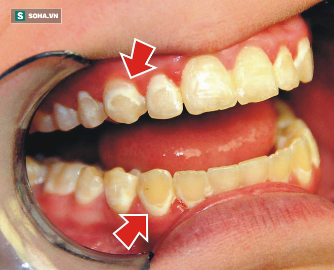  90% người Việt sâu răng, viêm lợi, mất răng... do thói quen sai lầm này: Bạn có mắc phải? - Ảnh 1.