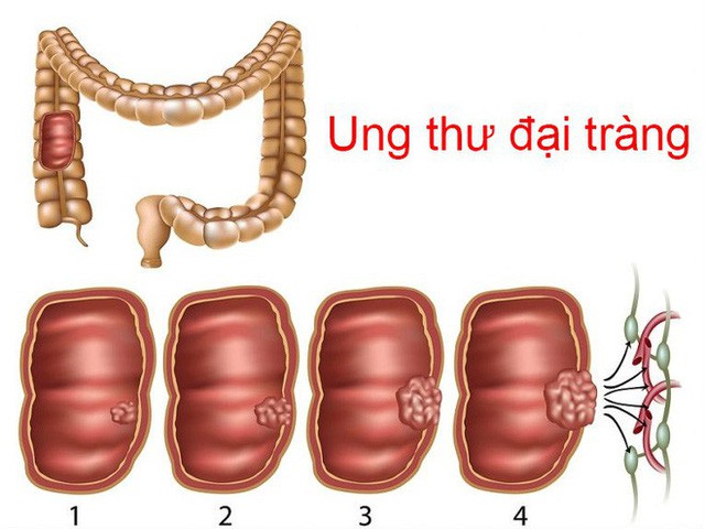 5 nhóm người dễ bị ung thư đại trực tràng, bác sĩ mong rằng không có bạn trong số đó  - Ảnh 1.