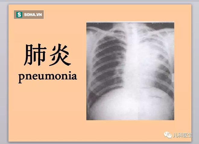 Những dấu hiệu nhận biết khi trẻ bị viêm phổi, phụ huynh nên nắm rõ để xử lý đúng cách - Ảnh 1.