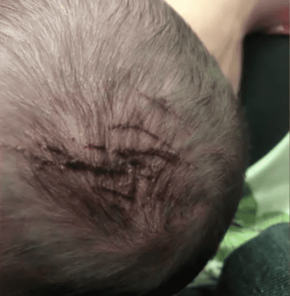 Bé gái chào đời với đỉnh đầu bị cào rách, gia đình tức giận yêu cầu lời xin lỗi từ phía bệnh viện - Ảnh 2.