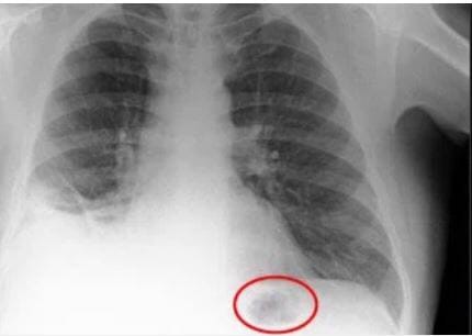 Ho dai dẳng nên đi khám, người đàn ông hoảng sợ khi bác sĩ thông báo có khối u ở phổi nhưng đến khi lấy ra mới ngã ngửa - Ảnh 2.
