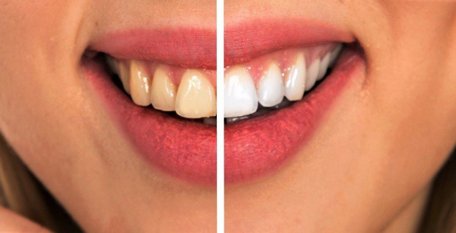 8 mẹo vặt hữu ích giúp bạn luôn nói không với bệnh sâu răng - Ảnh 5.