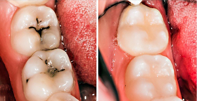 8 mẹo vặt hữu ích giúp bạn luôn nói không với bệnh sâu răng - Ảnh 6.
