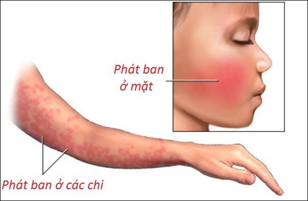 Bệnh phát ban đỏ nhiễm khuẩn cấp dễ gây nhầm lẫn ở trẻ nhỏ vào mùa đông - Ảnh 2.