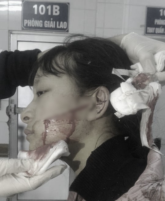 Thanh Hóa: Nữ sinh bị hàng xóm chém rách mặt vì nghi ăn cắp mẫu quần áo để bán - Ảnh 1. Thanh Hóa: Nữ sinh bị hàng xóm chém rách mặt vì nghi ăn cắp mẫu quần áo để bán - Ảnh 1.