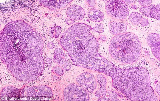 Phát hiện 110 gene mới gây ung thư vú - Ảnh 1. Phát hiện 110 gene mới gây ung thư vú - Ảnh 1.