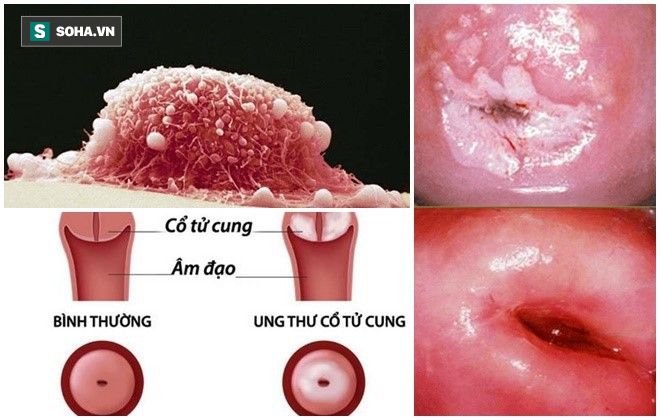 Thủ phạm khiến 7 phụ nữ Việt tử vong mỗi ngày, chị em cần làm ngay điều này để phòng tránh - Ảnh 1.