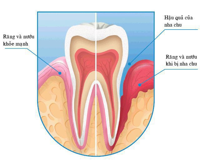 Phương pháp chữa sâu răng 100% tự nhiên rất dễ áp dụng tại nhà - Ảnh 3.