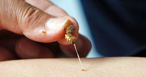 Bị ong đốt cần làm những gì để sơ cứu kịp thời, tránh biến chứng nguy hiểm cũng như nguy cơ tử vong? - Ảnh 3.