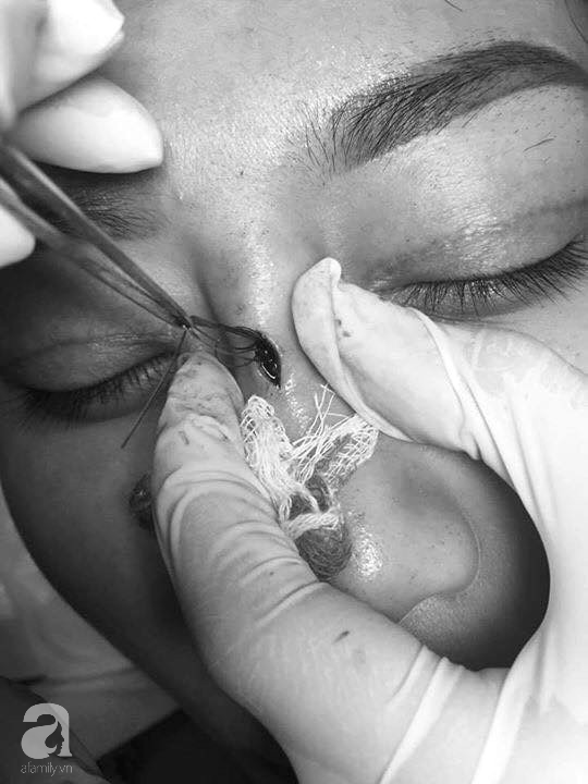 Cô gái 22 tuổi ở Bạc Liêu bị hủy hoại dung nhan vì đi nâng mũi bằng chỉ - Ảnh 1.