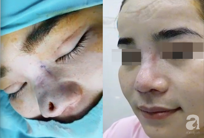 Cô gái 22 tuổi ở Bạc Liêu bị hủy hoại dung nhan vì đi nâng mũi bằng chỉ - Ảnh 4.