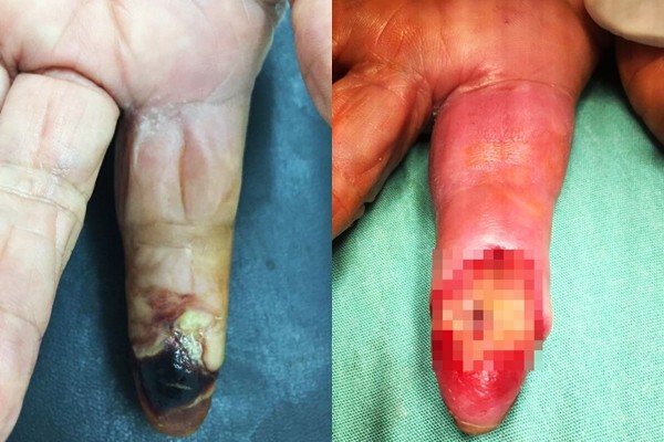 TP.HCM: Bị gai tôm đâm, cụ bà 80 tuổi suýt mất ngón tay vì hoại tử - Ảnh 1.