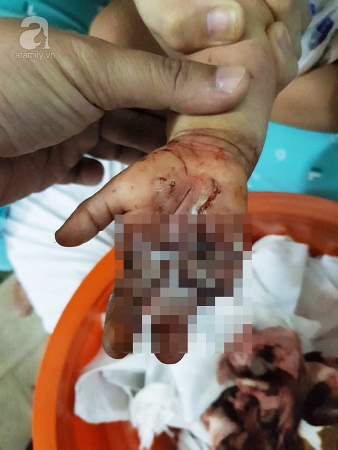 Long An: Bé trai 3 tuổi bị dây sên xe máy cuốn đứt lìa hai ngón tay - Ảnh 3.