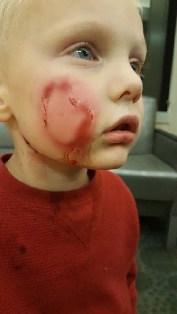 Bức ảnh kinh hoàng chụp bé trai bị biến dạng khuôn mặt vì 2 con chó tấn công - Ảnh 4.