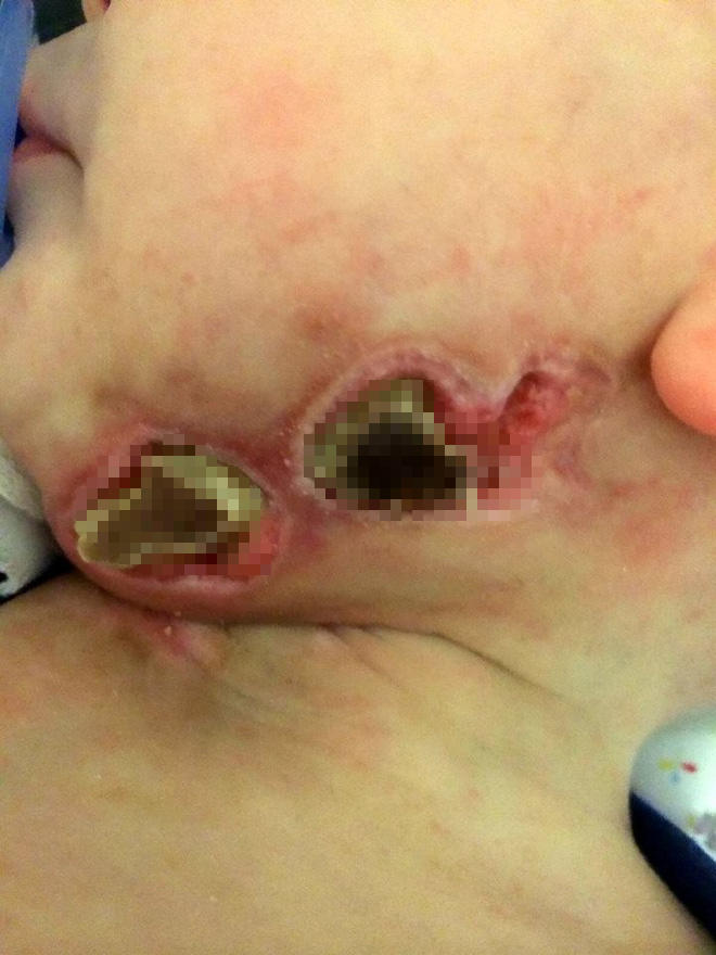 Nhiễm vi khuẩn ăn thịt người do biến chứng từ căn bệnh phổ biến, bé trai 13 tháng tuổi tính mạng nguy kịch - Ảnh 3.