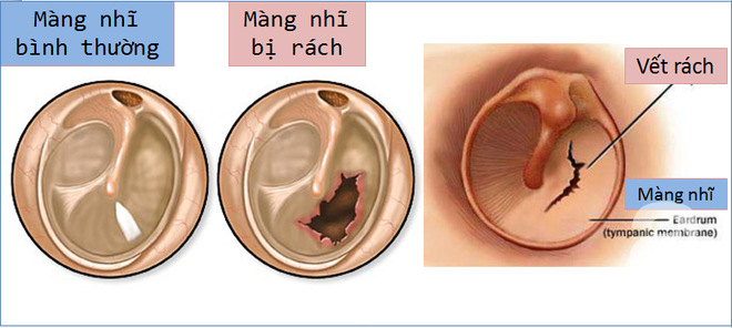 Bé gái bị thủng màng nhĩ đau đớn do sự chủ quan của người mẹ - Ảnh 3.