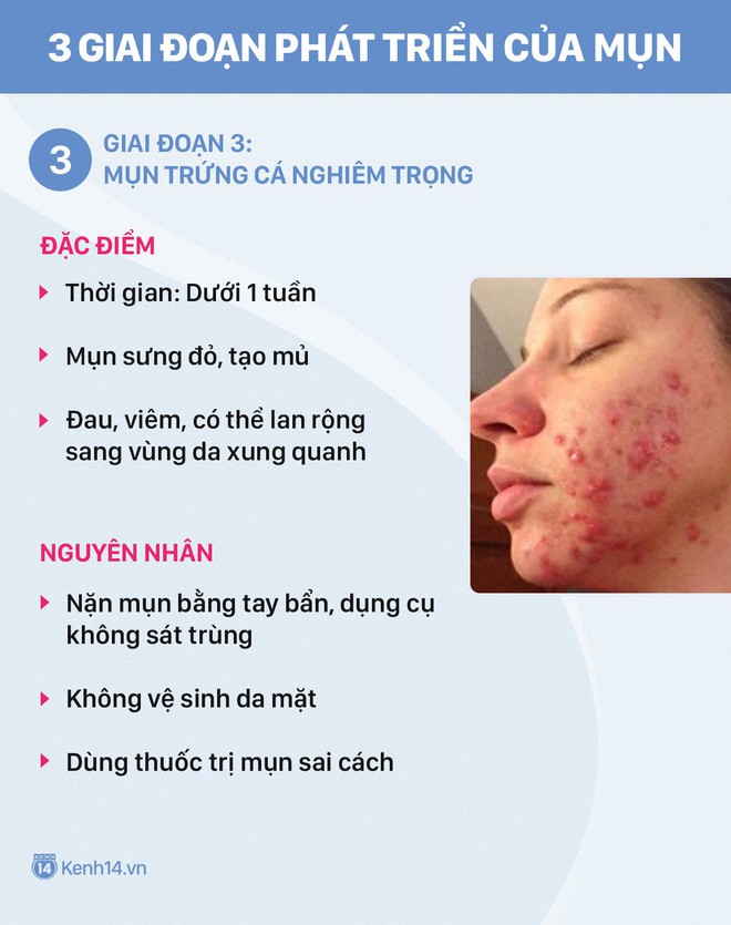 Muốn chữa mụn trứng cá hiệu quả cũng phải biết cách trị theo đúng giai đoạn - Ảnh 4.