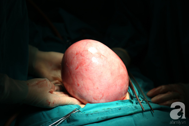 Phát hiện khối u nặng hơn 2kg ở ổ bụng sau thời gian rong kinh kéo dài - Ảnh 2.