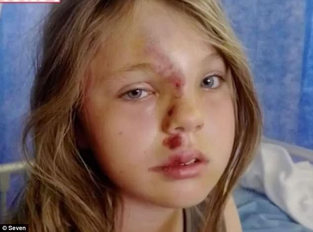 Con gái bất ngờ bị hủy hoại gương mặt sau tai nạn thảm khốc, mẹ tuyệt vọng chỉ biết làm cách này để cứu con - Ảnh 2.